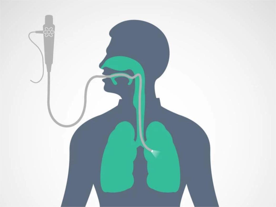 电子支气管镜在医疗实践中的应用 电子支气管镜在医疗实践中的应用