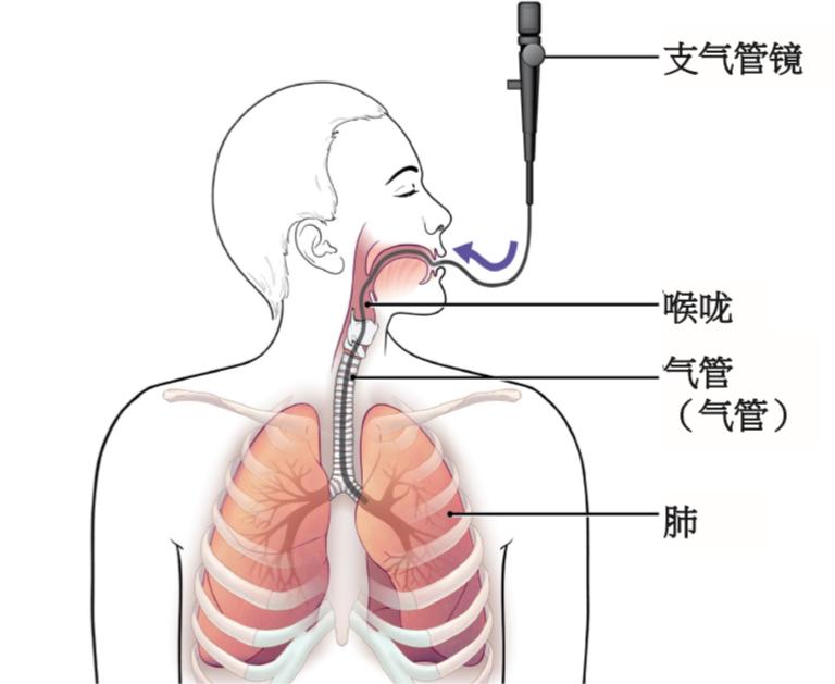 喉镜厂家给您介绍:可视软性喉镜的操作技巧 喉镜厂家给您介绍:可视软性喉镜的操作技巧